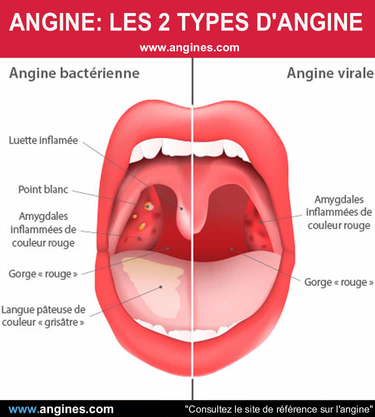 Angine : Angine bactérienne et angine virale