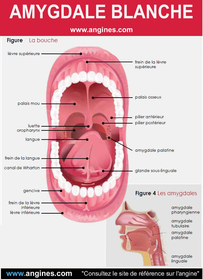 Angine : Amygdales blanches