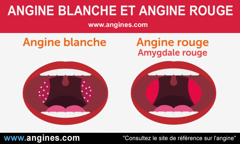 Angine : Angine rouge et angine blanche