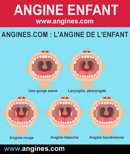 Angines : Angine chez l'enfant