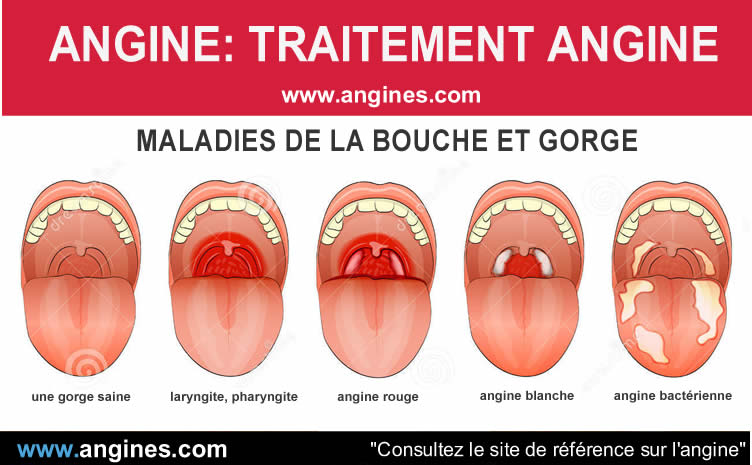 Angine : Traitement angine