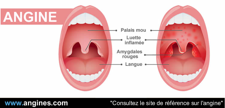 Angine : Les angines