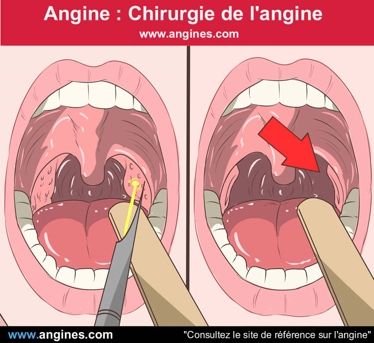 Angine : Chirurgie angine