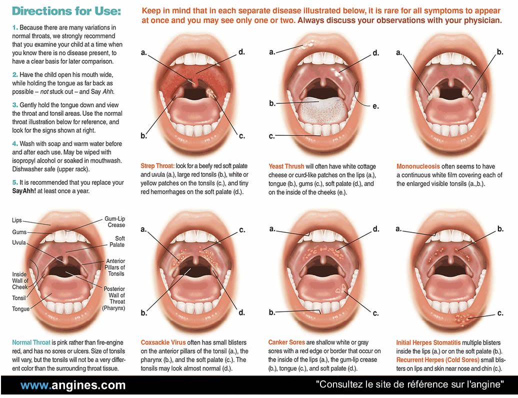 Mal de gorge : Angines