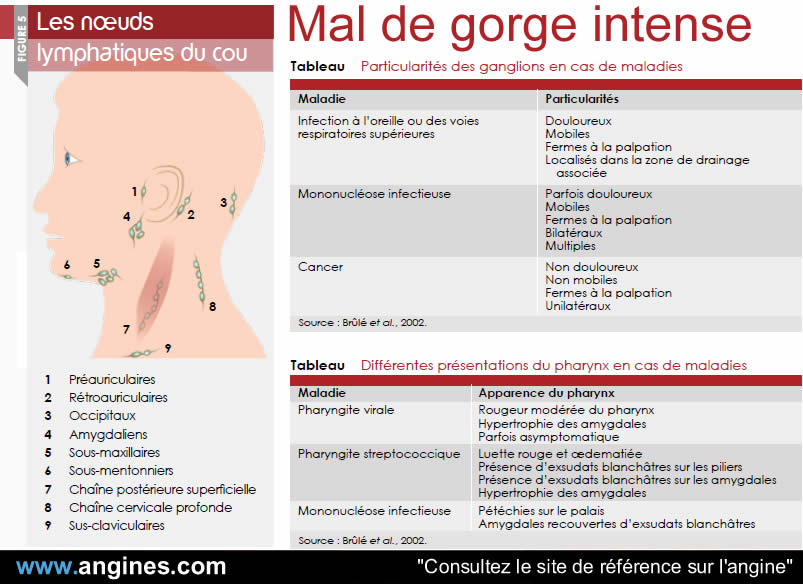 Angine : Maux de gorge intense