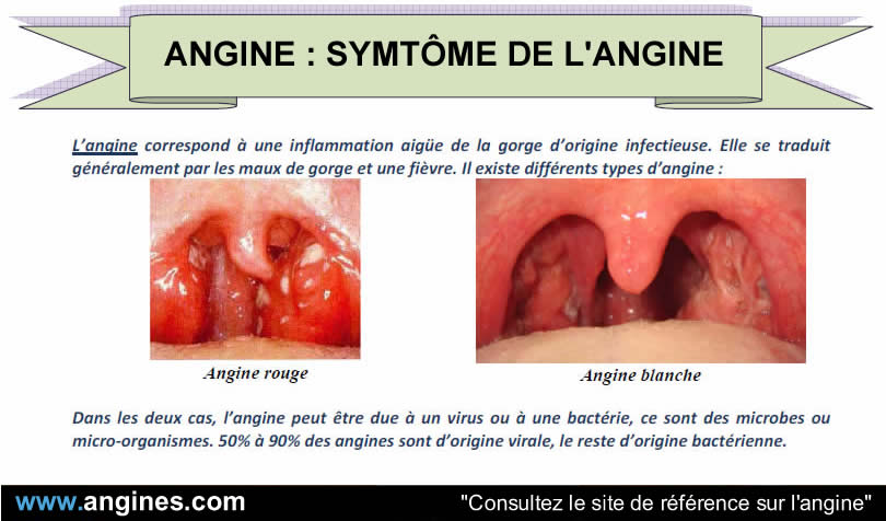 Angine : Symptôme de l'angine