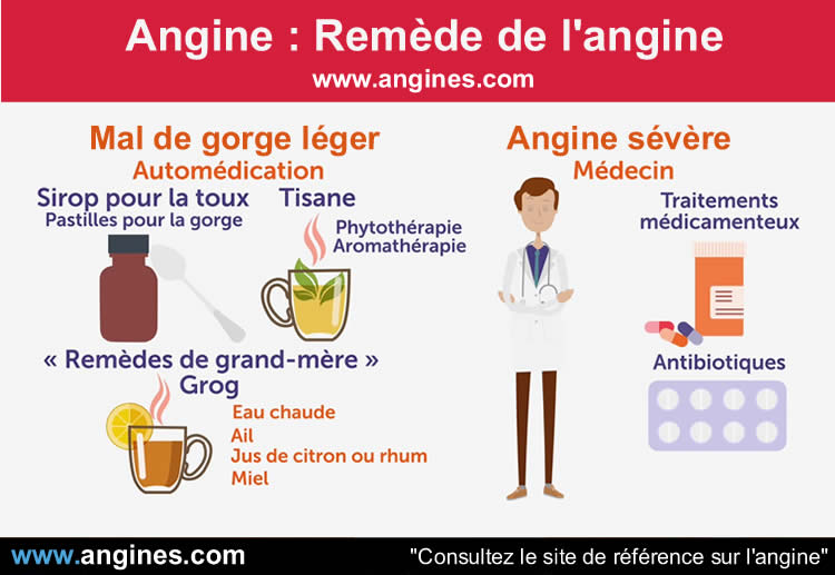 Angine : Homéopathie des angines