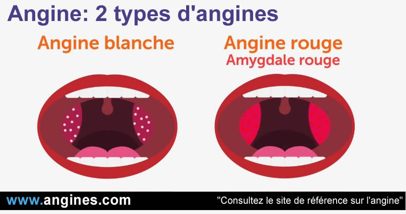 Angine : Types d'angine
