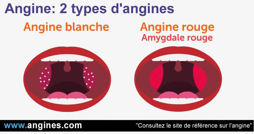 Angine Tout Savoir Sur Les Angines Le Site De R f rence